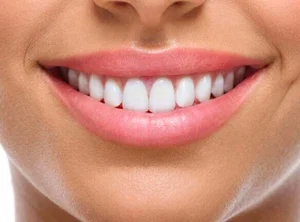 How to Prepare for Your Visit to a Hollywood Smile Clinic
